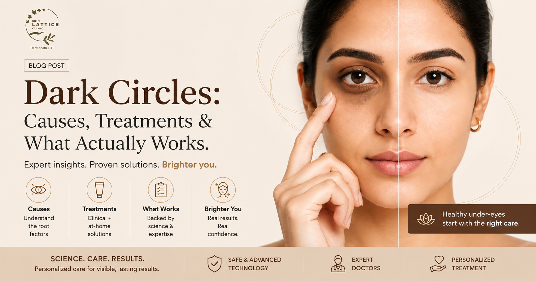 Dark Circles: Causes, Treatments